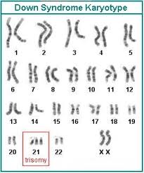 Human Chromosomal Abnormalities: Autosomal Abnormalities
