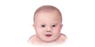 Facts about Down Syndrome | CDC