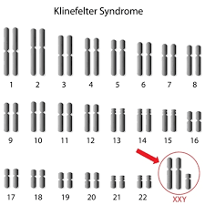 Klinefelter syndrome: MedlinePlus Genetics